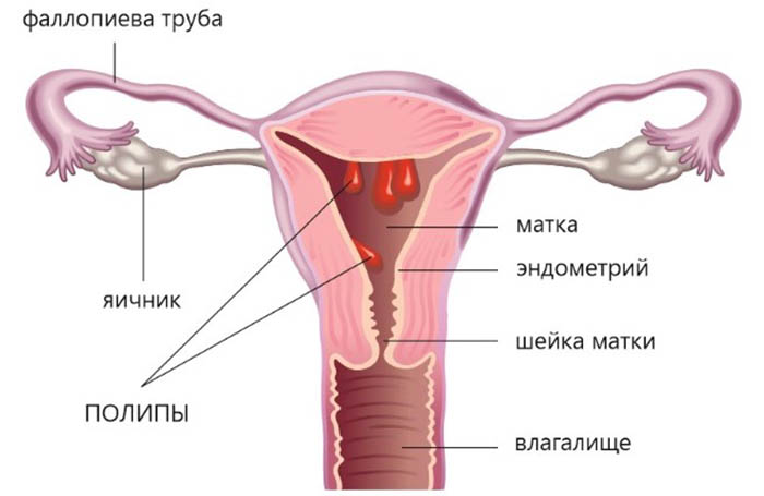 Полип эндометрия. Симптомы, признаки в матке, отчего появляются