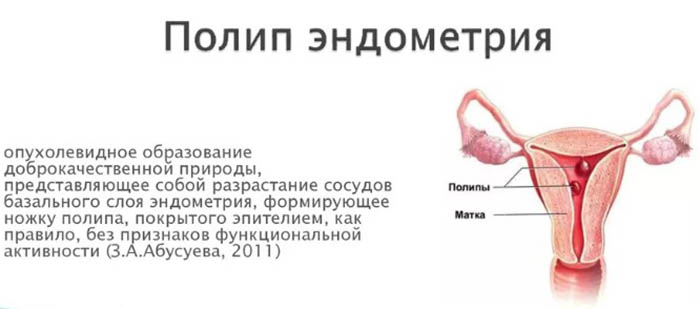 Полип эндометрия. Симптомы, признаки в матке, отчего появляются
