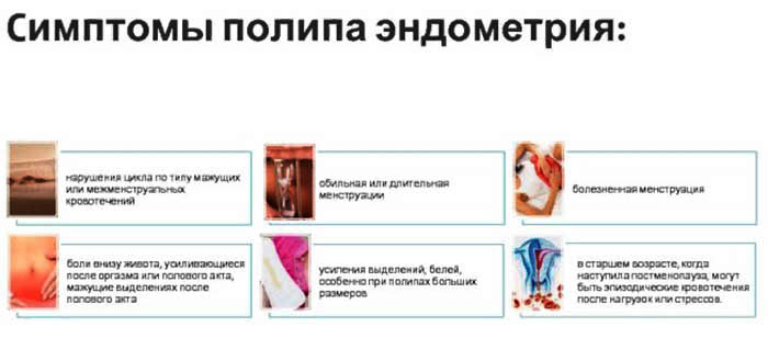 Полип эндометрия. Симптомы, признаки в матке, отчего появляются