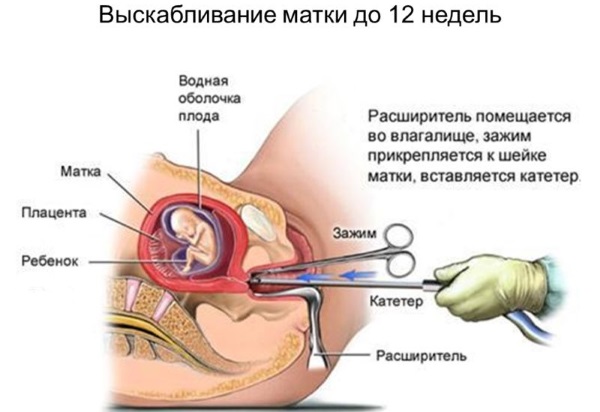 Прерывание беременности на ранних сроках. Таблетки, народные средства, процедуры