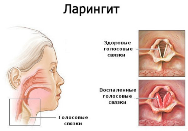 Пропал голос от простуды, болит горло. Как лечить лекарствами, народными средствами, таблетками, полосканием
