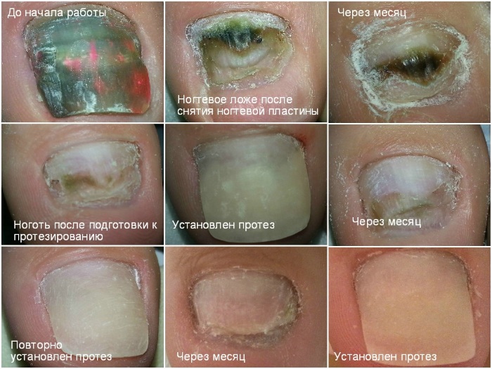 Протезирование ногтей на ногах, руках гелем Gehwol, полигелем, акрилом. Фото, цены, отзывы