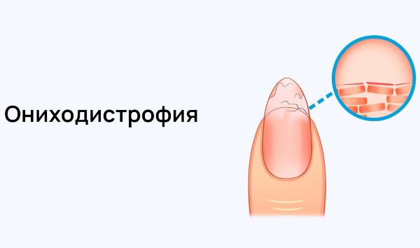 Псориаз ногтей (ониходистрофия) на ногах, руках. Фото, лечение