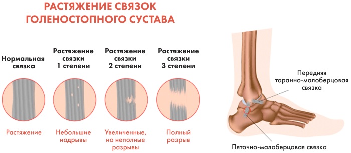 Связки коленного сустава: анатомия, строение, травмы и лечение, как укрепить