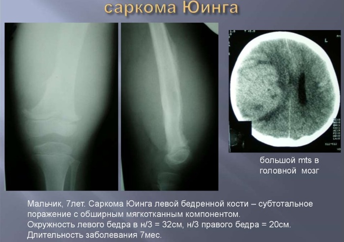 Саркома тазобедренного сустава. Симптомы у детей, что такое остеогенная, синовиальная, Юинга, признаки, лечение, фото
