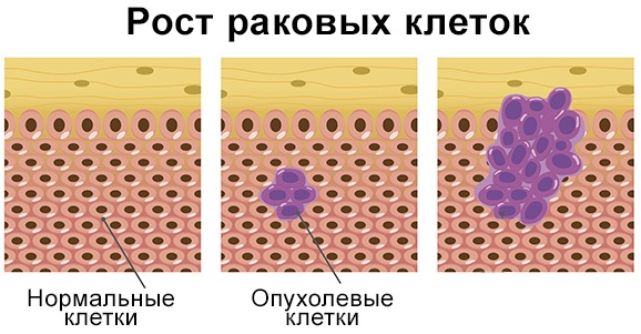 Саркома тазобедренного сустава. Симптомы у детей, что такое остеогенная, синовиальная, Юинга, признаки, лечение, фото