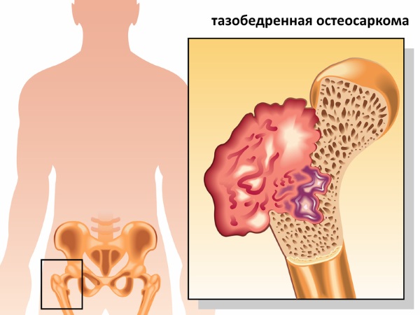 Саркома тазобедренного сустава. Симптомы у детей, что такое остеогенная, синовиальная, Юинга, признаки, лечение, фото