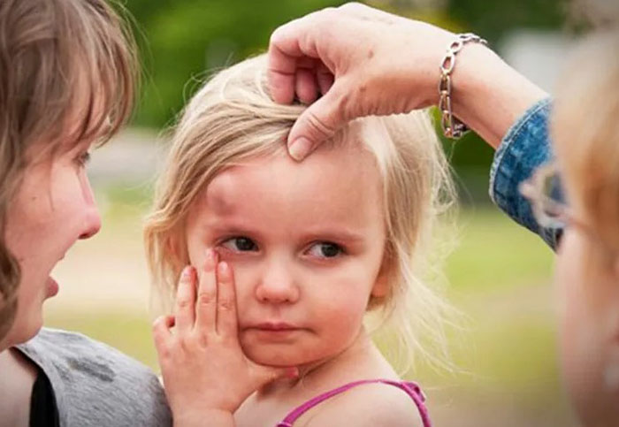 Шишка на лбу от удара. Как быстро убрать, чем мазать