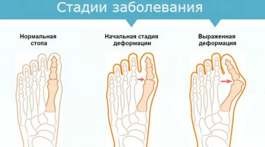 Шишка на пальце ноги. Лечение народными средствами артрита в домашних условиях: мази, кремы, рецепты народной медицины