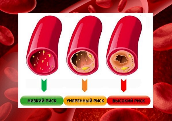 Профилактика гипертонической болезни
