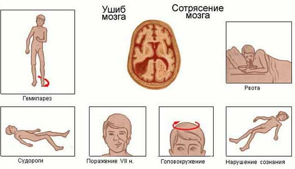 Боль во лбу над переносицей, в глазах, при наклоне. Причины