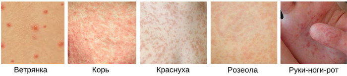 Сыпь при краснухе. Фото, диф. диагноз, диагностика