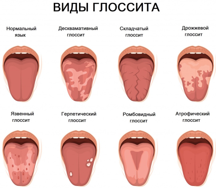 Типун на языке. Как лечить, убрать прыщик у ребенка, взрослого