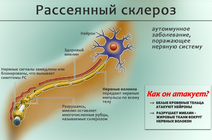Покалывание в руках и ногах как иголки одновременно. Причины, лечение