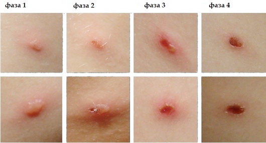 Ветрянка во рту. Фото, температура, сколько проходит, лечение