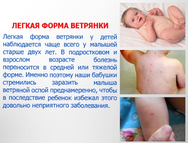 Ветрянка у детей: начало, симптомы, лечение в домашних условиях, инкубационный период, профилактика. Советы Комаровского