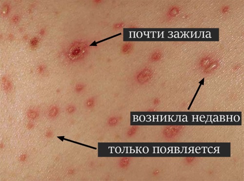 Ветрянка у детей: начало, симптомы, лечение в домашних условиях, инкубационный период, профилактика. Советы Комаровского