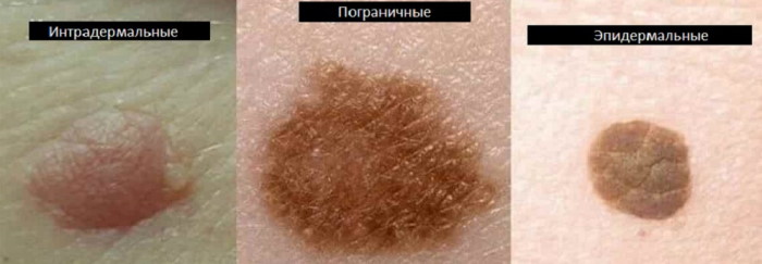 Виды родинок на теле, лице. Фото с описанием, опасны или нет