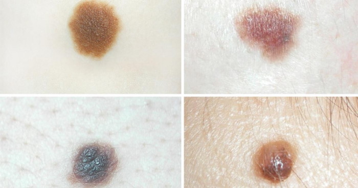Виды родинок на теле, лице. Фото с описанием, опасны или нет