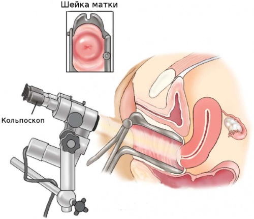 Лейкоплакия шейки матки. Отзывы, что это такое, лечение лазером, народными средствами