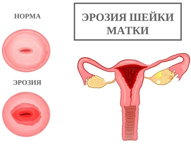 Пена в моче у женщин. Причины и лечение в домашних условиях