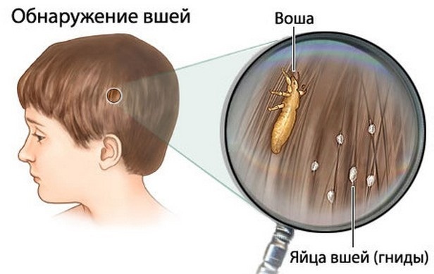 Вши у ребенка. Что делать? Средства лечения