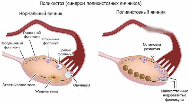 Поликистоз яичников. Симптомы и причины возникновения