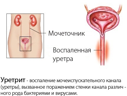 Жжение при мочеиспускании у женщин. Причины боли, резь, кровь, дискомфорт, частые позывы ночью. Лечение