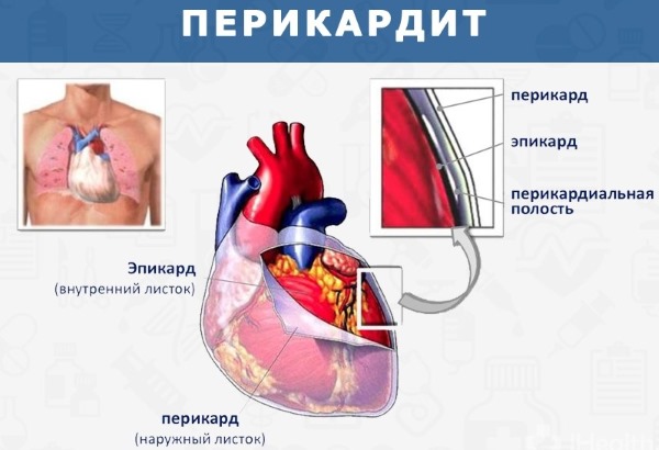 Жжение в области сердца. Причины за грудиной ощущение тяжести, боль. Что делать
