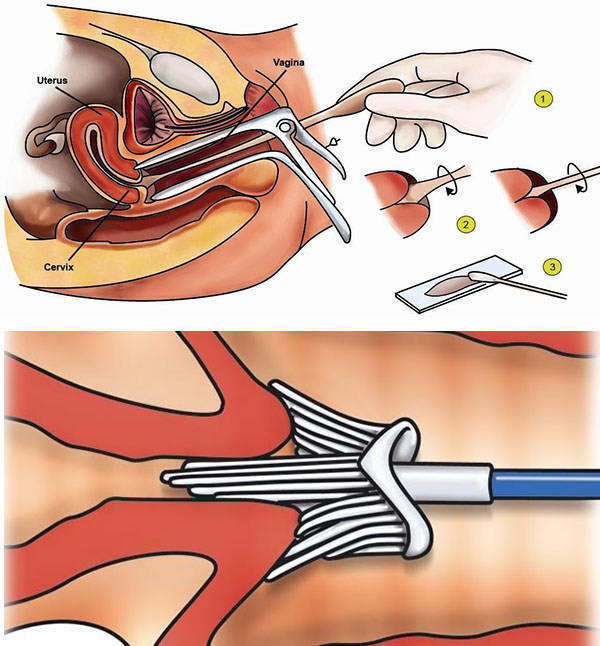Заболевания шейки матки. Список, классификация, клинические рекомендации